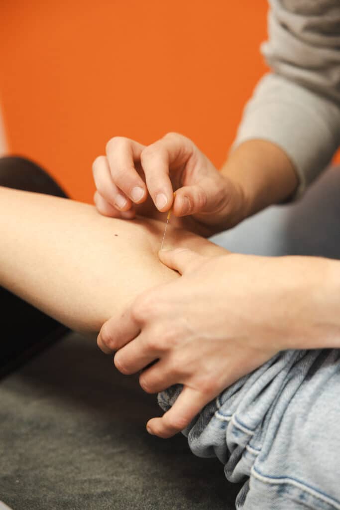 Fysiotherapeut behandelt gespannen spieren met dry needling
